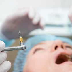 A dental implant surgery