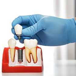 A dentist showing how an abutment fits on a dental implant