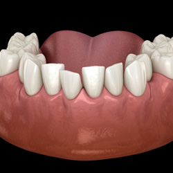 Close-up of crowded teeth before SureSmile 