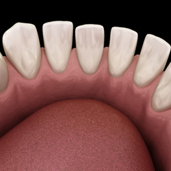 Warrenton patient with noticeable gap between teeth 