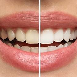 Closeup of a smile that’s half whitened